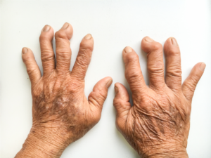 更年期の関節痛の成れの果てがへバーデン結節といわれています。